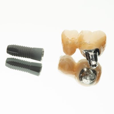 dental implant, dental implants, dental implant bridge